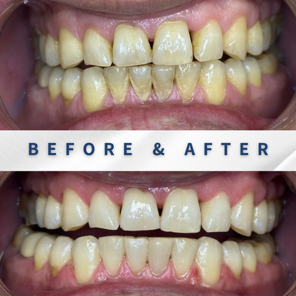 הלבנת שיניים מקצועית