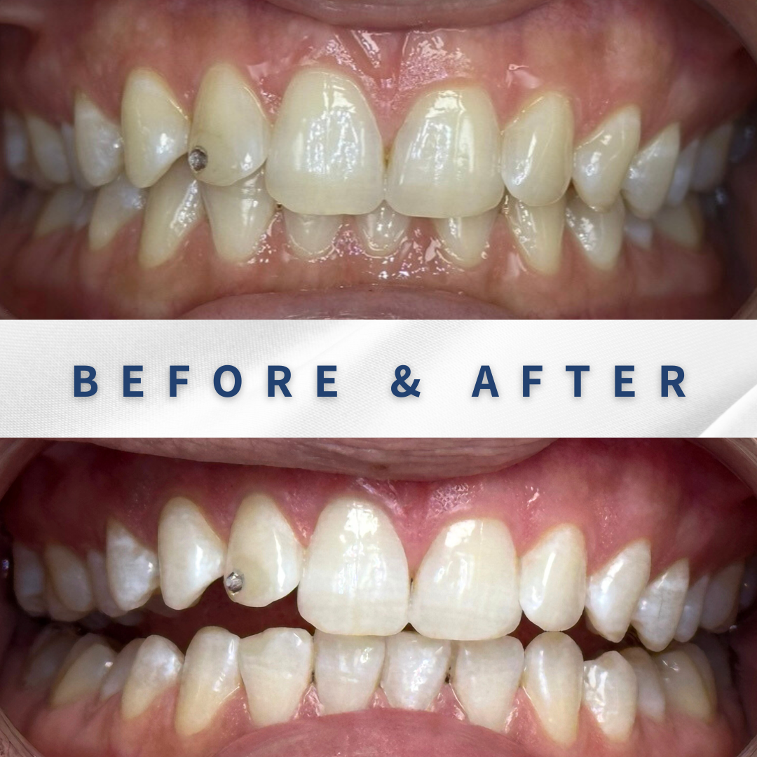 הלבנת שיניים מקצועית